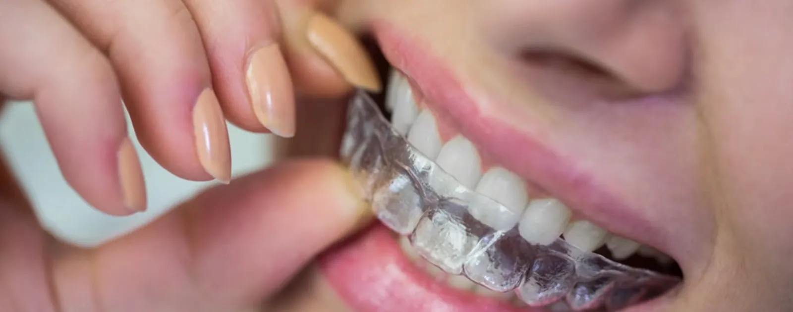 Invisalign